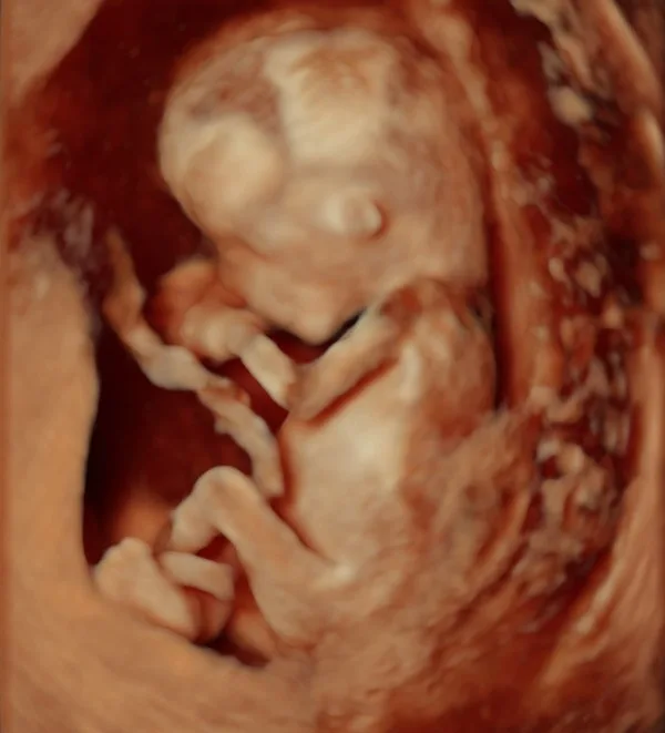 Ultrasonido obstétrico 3D del feto para evaluación prenatal y seguimiento de embarazo de alto riesgo en medicina materno fetal.