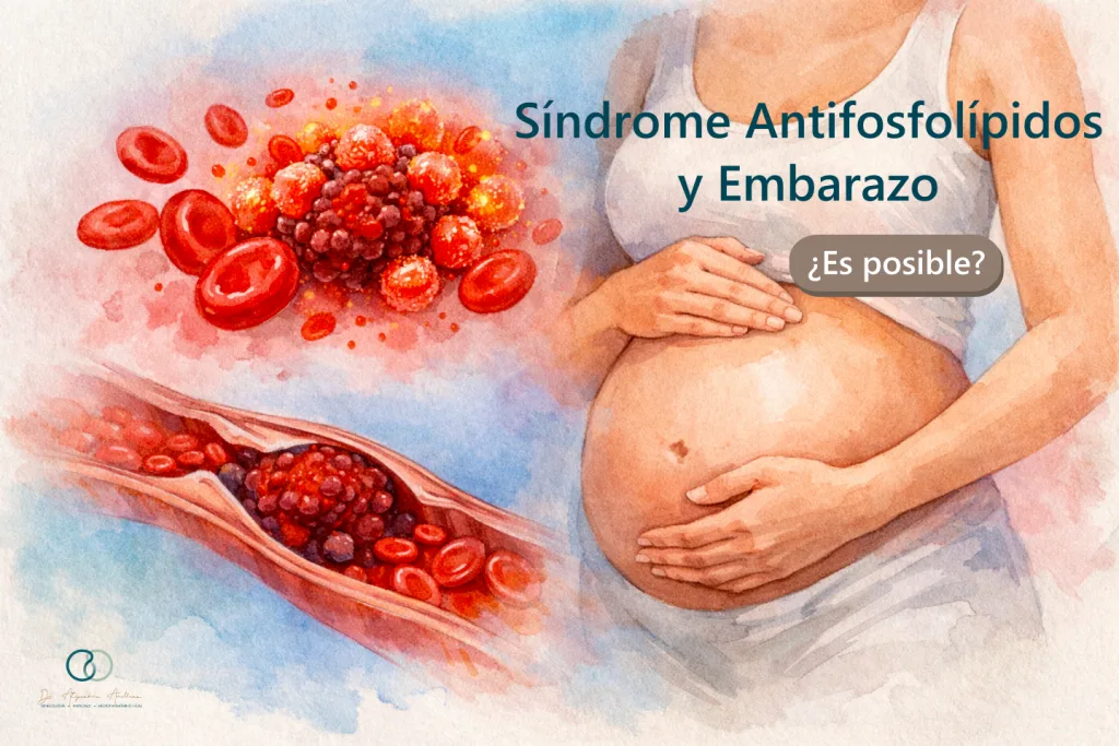 Ilustración médica en acuarela de embarazo con síndrome antifosfolípidos, mostrando anticuerpos y afectación de un vaso sanguíneo por un trombo.